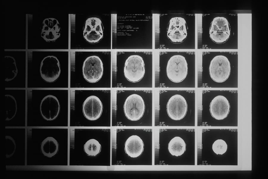A black and white photo of various brain MRI.